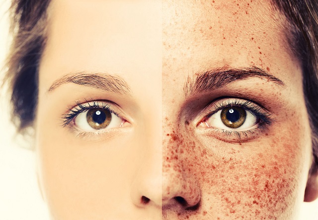 How To Get Rid Of Sunspots On Face Quickly My Bios how-to-get-rid-of-sunspots-on-face-quickly-my-bios