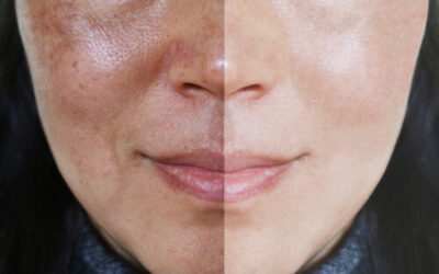 How to Get Rid of Skin Discoloration with Skin Resurfacing Treatments