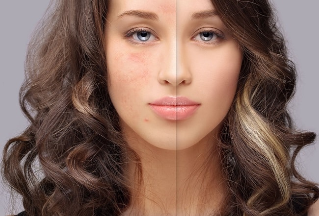 rosacea treatment x