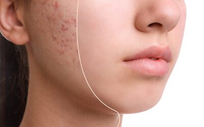 Introducing AviClear®: The Acne Laser Treatment Solution for All Skin Tones