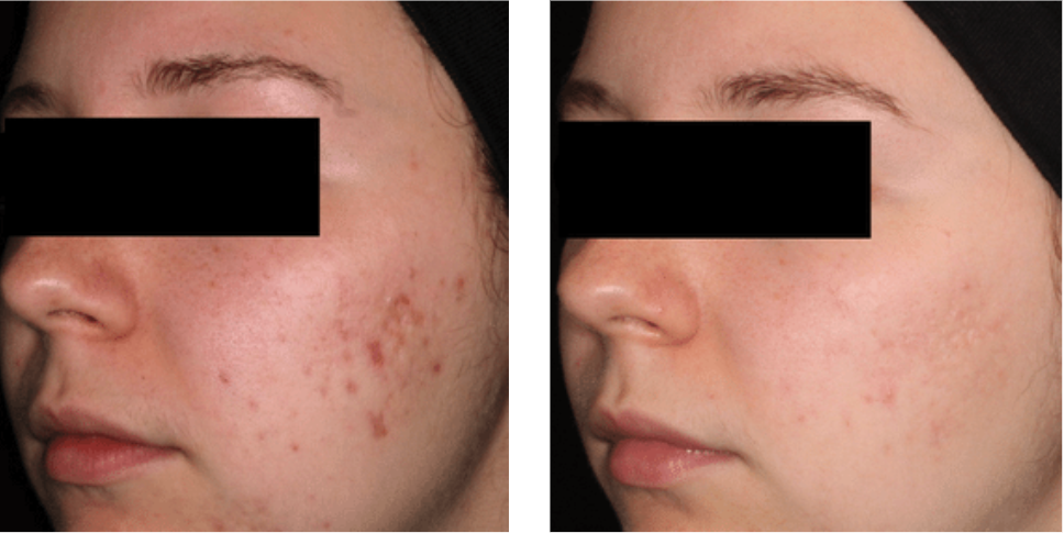 AviClear Before After AviClear Before After