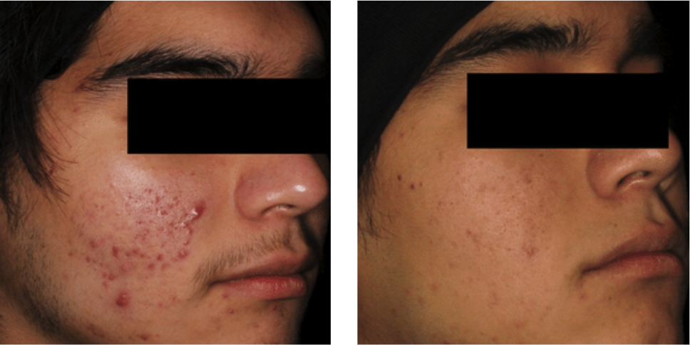 AviClear Before After AviClear Before After