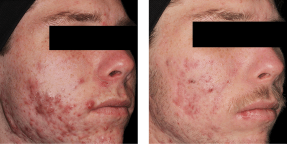AviClear Before After AviClear Before After
