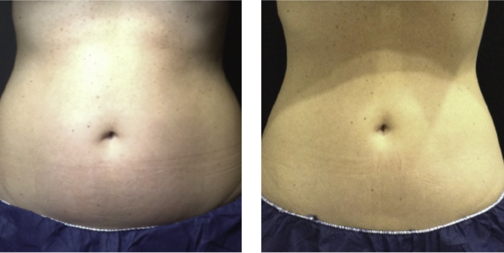 CoolSculpting Elite before after