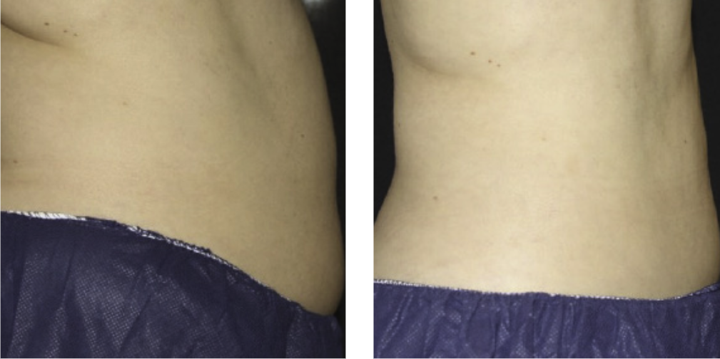 CoolSculpting Elite before after