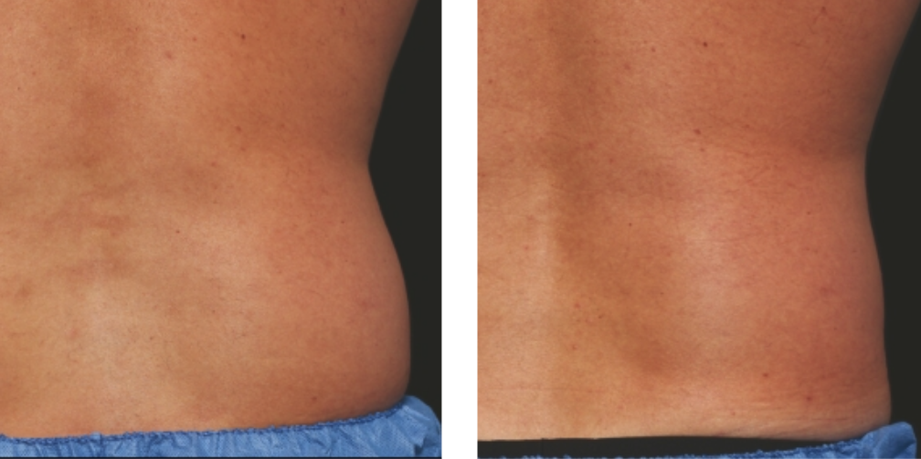 CoolSculpting Elite before after