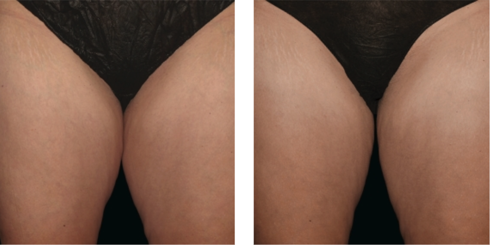 CoolSculpting Elite before after