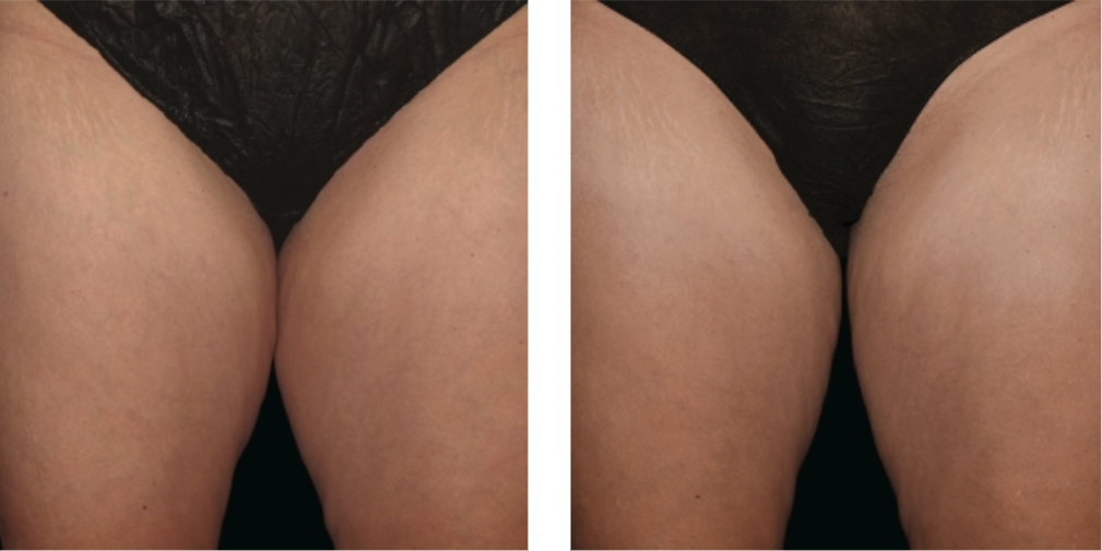 CoolSculpting Elite before after CoolSculpting Elite before after