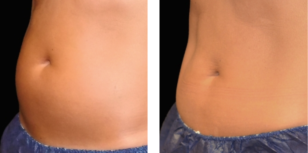 CoolSculpting Elite before after