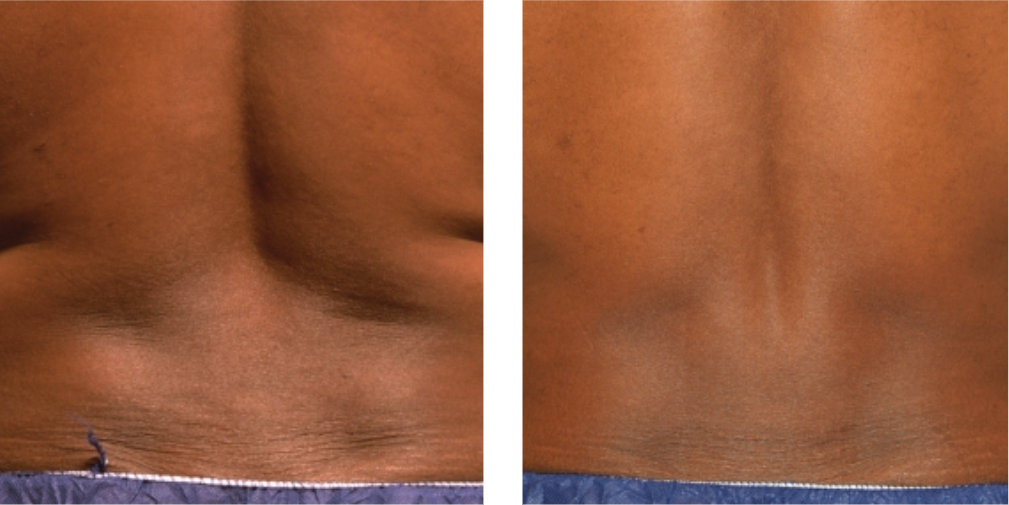 CoolSculpting Elite before after