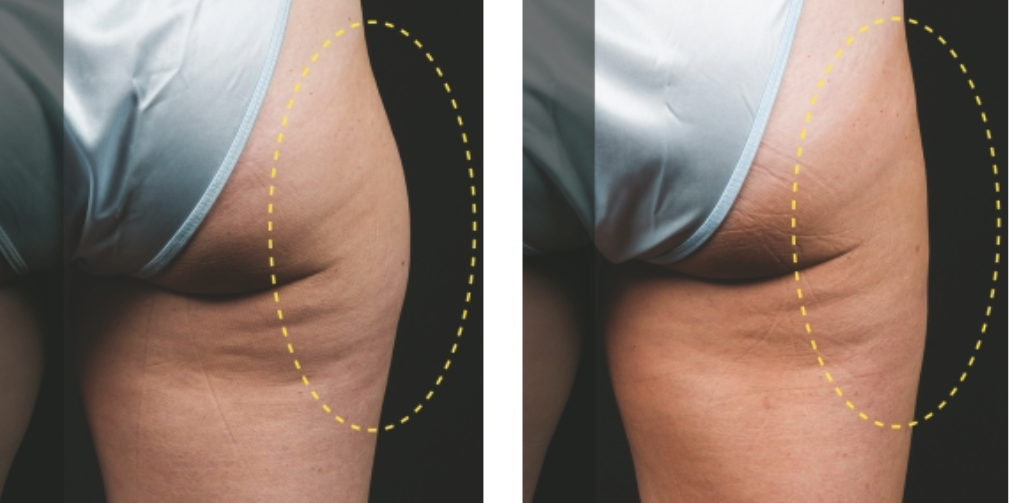 CoolSculpting Elite before after