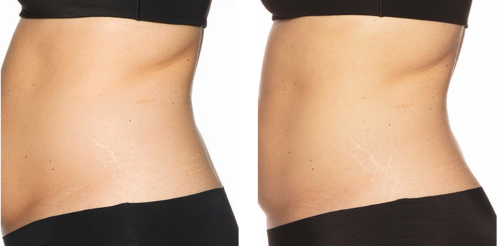 CoolSculpting Elite before after