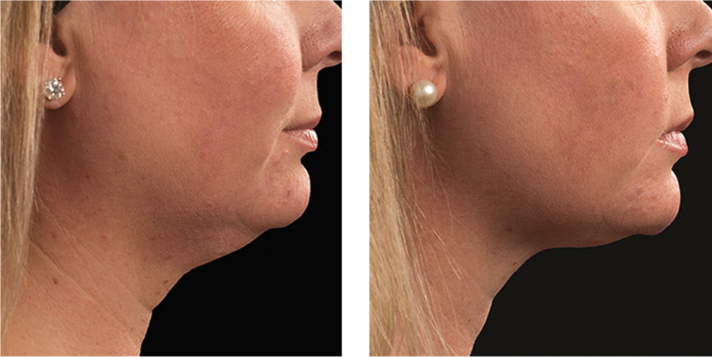 CoolSculpting Elite before after