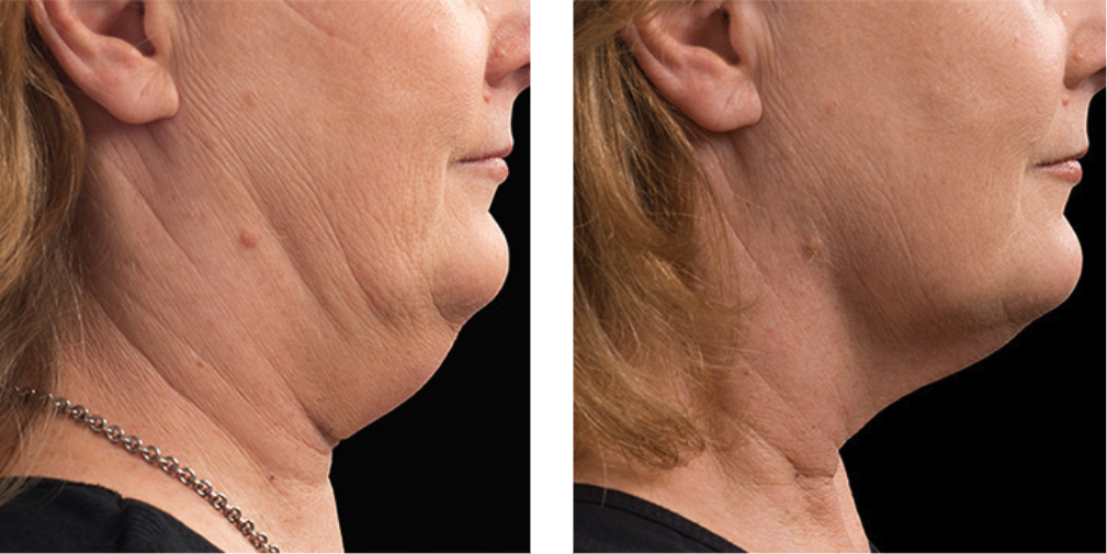 CoolSculpting Elite before after