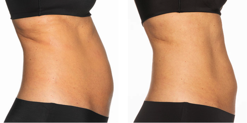CoolSculpting Elite before after