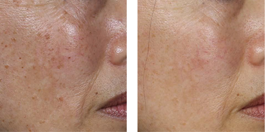 IPL photo facial before after IPL photo facial before after