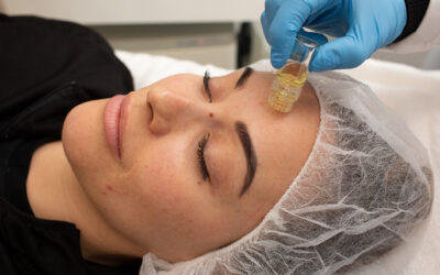 Rejuvenate Your Skin with Exosome-Enhanced Microneedling at Tribeca Medspa