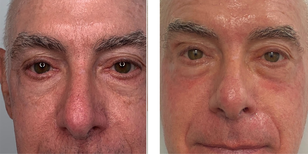 Morpheus before after Morpheus before after