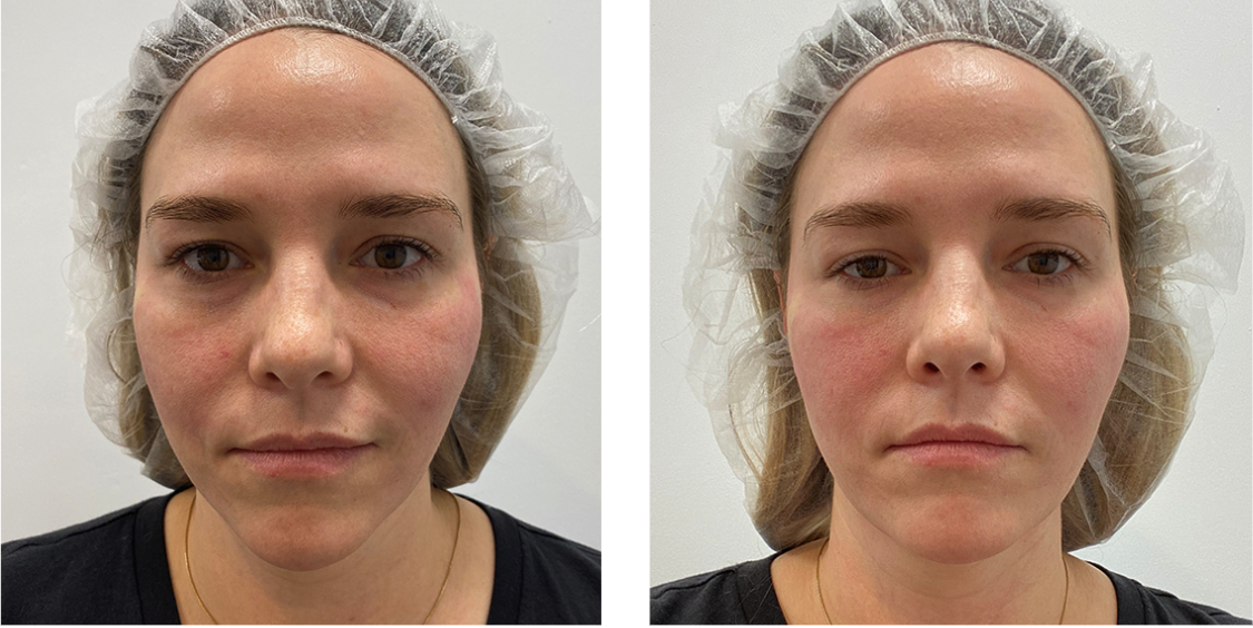 PDO Thread Lift before after PDO Thread Lift before after