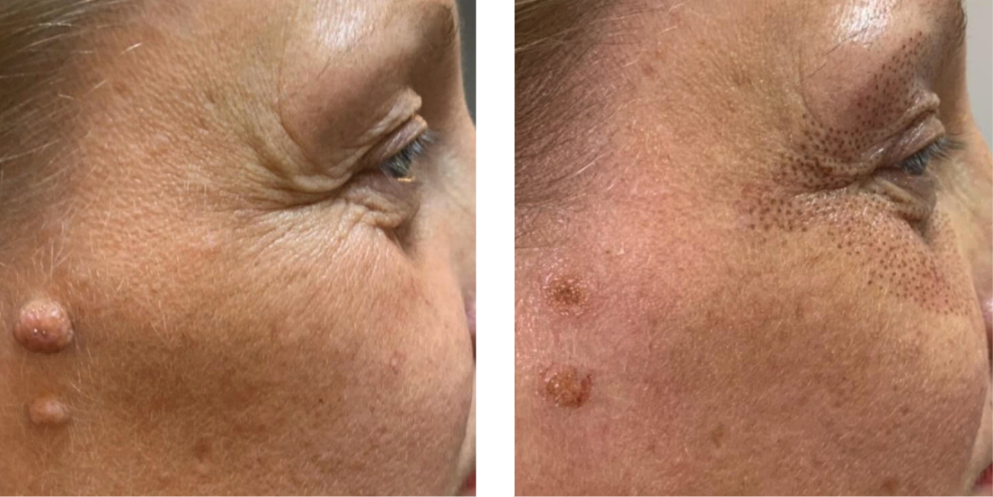 Plasma Fibroblast before after Plasma Fibroblast before after