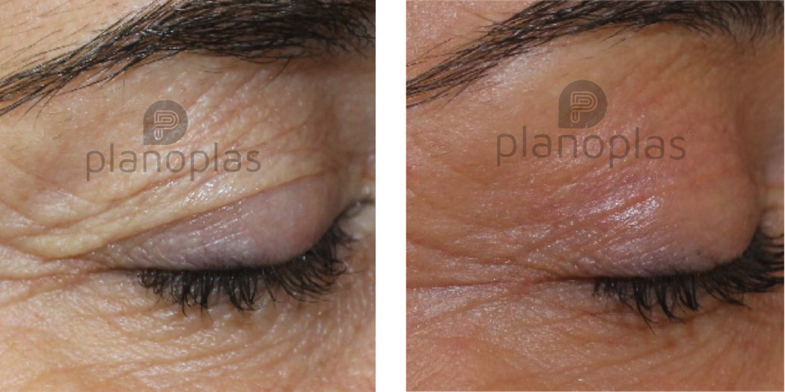 Plasma Fibroblast before after Plasma Fibroblast before after