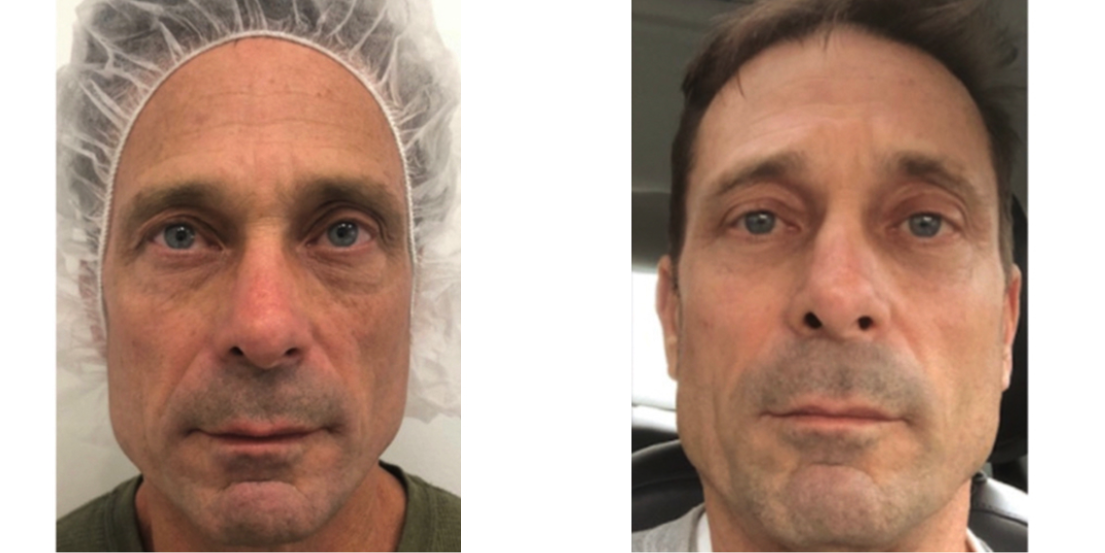 Plasma Fibroblast before after Plasma Fibroblast before after