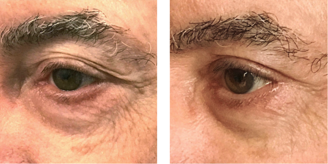 Plasma Fibroblast before after Plasma Fibroblast before after