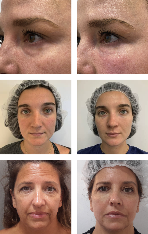 patients showing before after for dermal fillers
