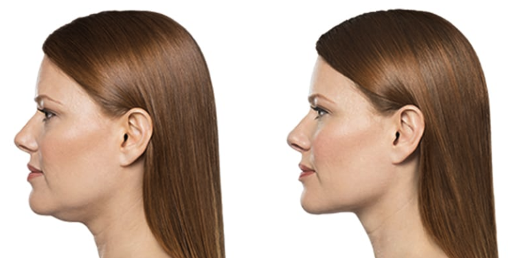 Kybella before and after