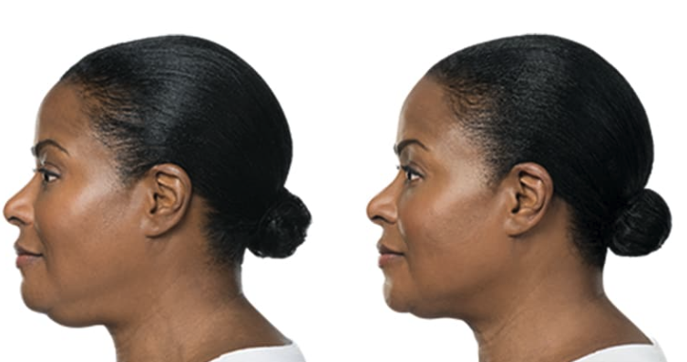 Kybella before and after