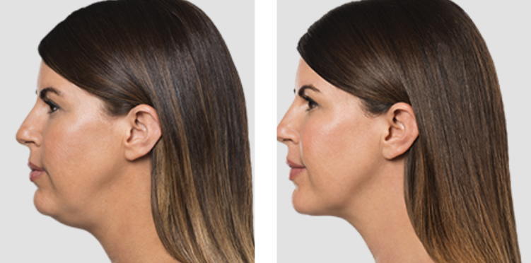 Kybella before and after Kybella before and after