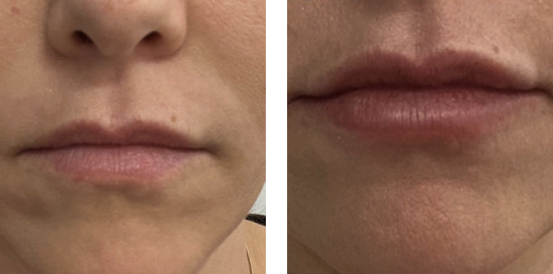 Lip filler before and after