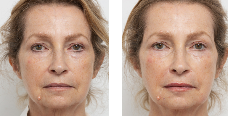 non surgical facelift before and after