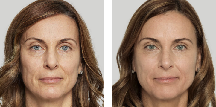 Sculptra before and after