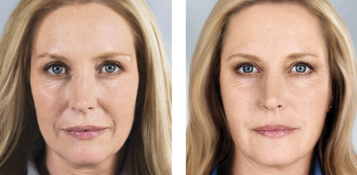 Sculptra before and after