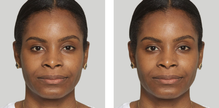 Sculptra before and after