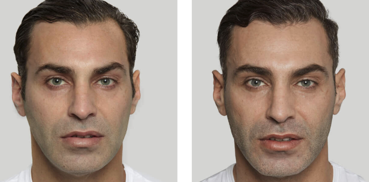 Sculptra before and after