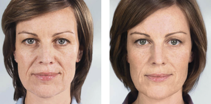 Sculptra before and after