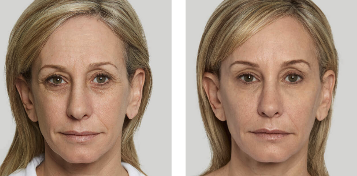 Sculptra before and after