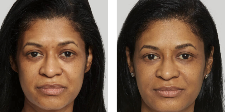 Sculptra before and after