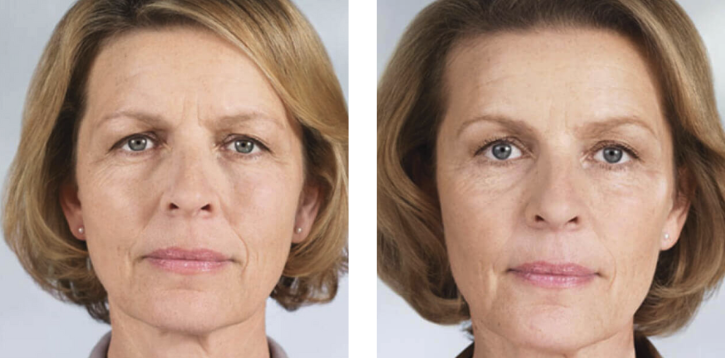 Sculptra before and after