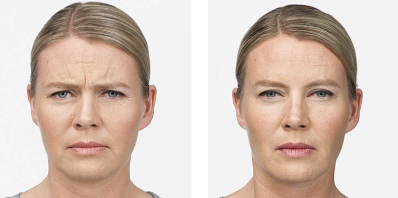 xeomin before and after xeomin before and after