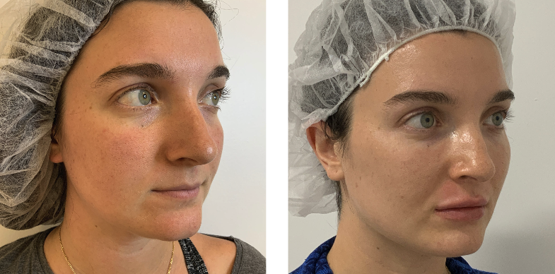 Microneedling and IPL before and after