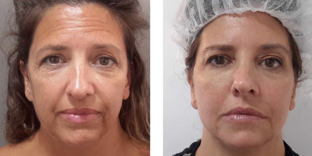 injectables before and after