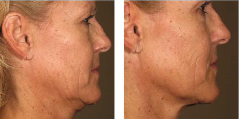 Ultherapy before after