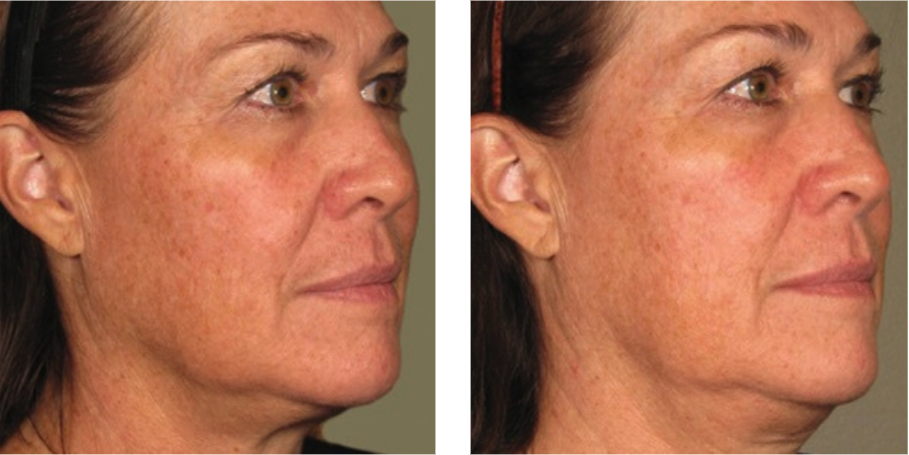 Ultherapy before after