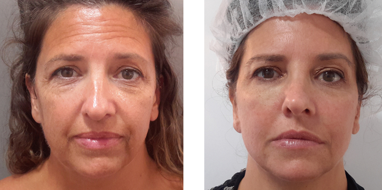 before after before after