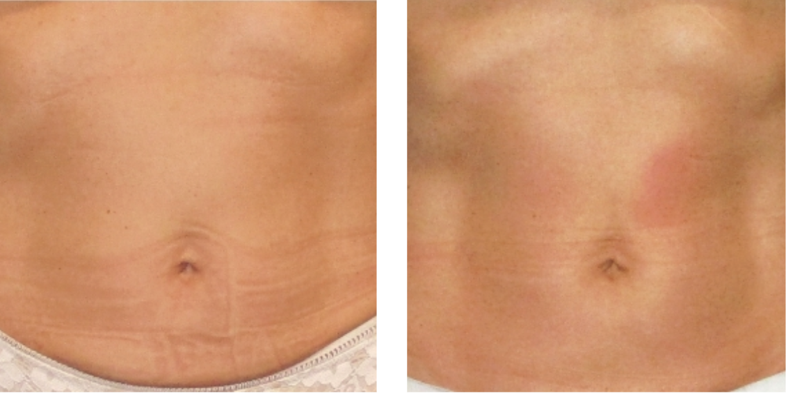 cooltone before after cooltone before after