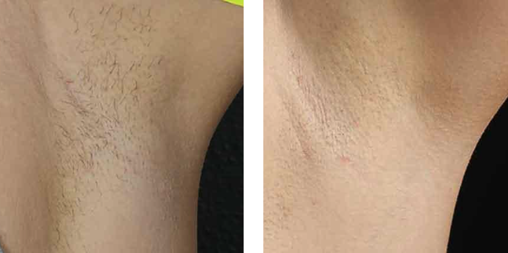 laser hair removal before after