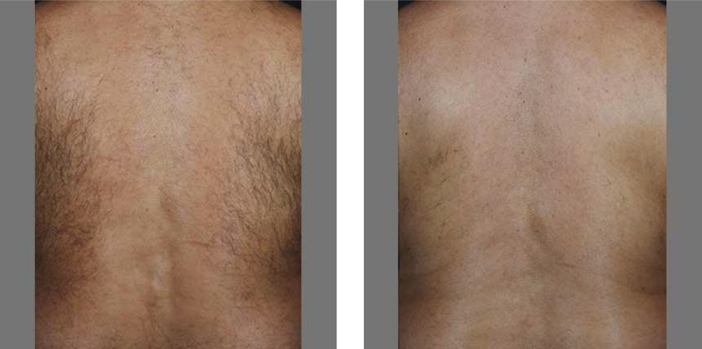 laser hair removal before after